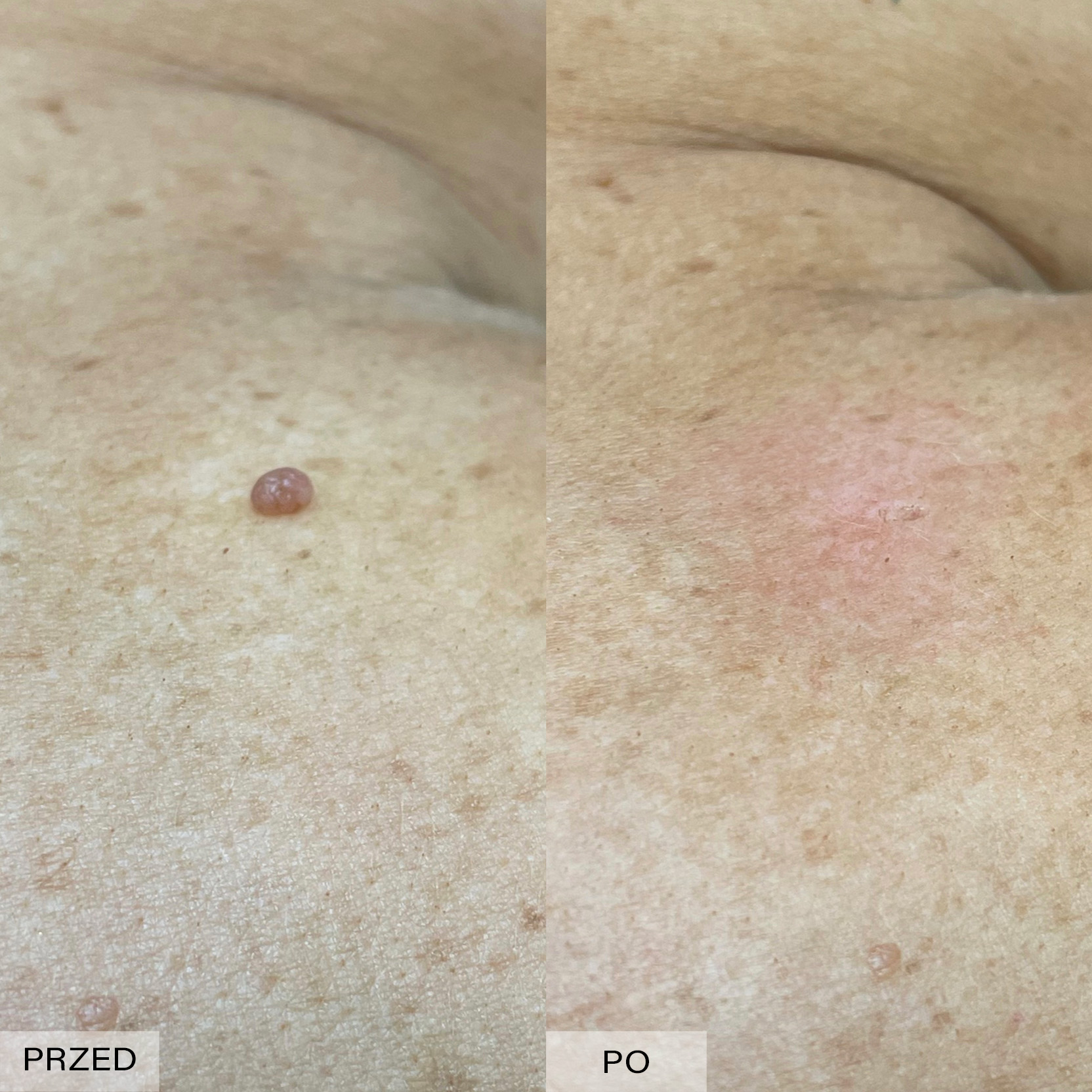 Efekt elektrokoagulacji